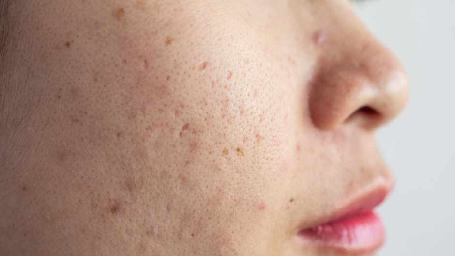 hyperpigmentation